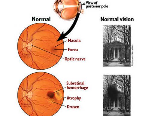 Macular Desecration Can Be Improved Video