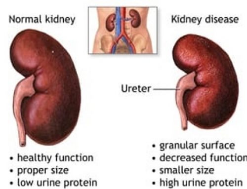 Kidney Disease 101 – The Basics