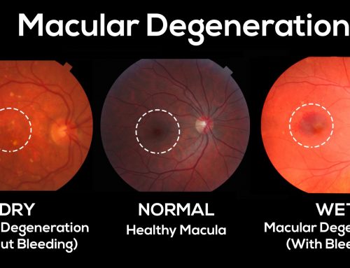 Age Related Macular Degeneration Information